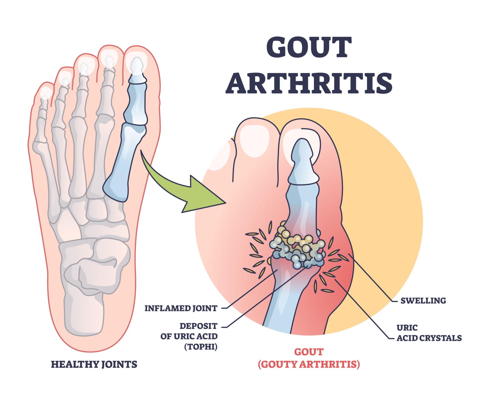 gout multiple choice questions